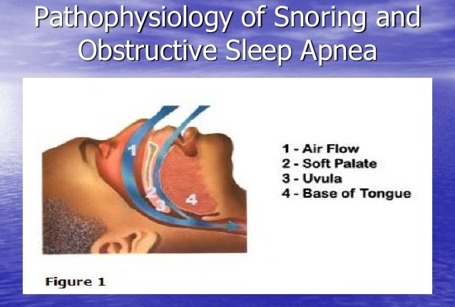 A summary Of Snoring, Sleep And Sleep Apnea