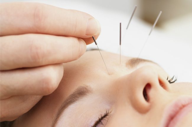 Acupuncture Weight Loss: More Than Just Needles