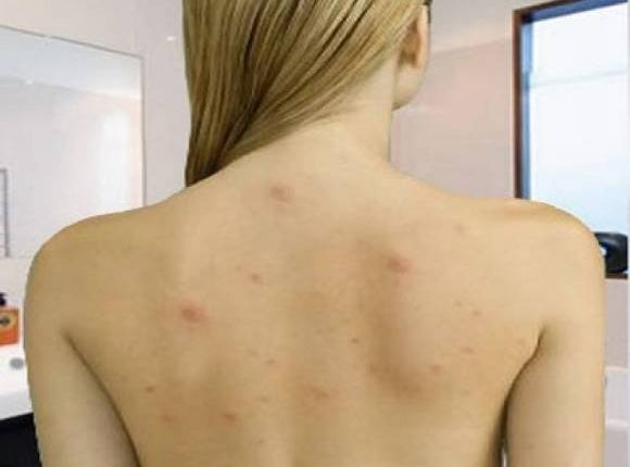 Ways to Deal With Back Acne